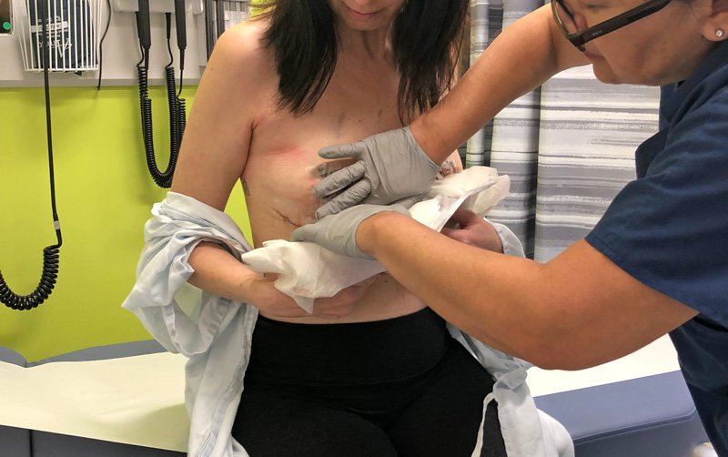 Post Explant - Bandage Removed
