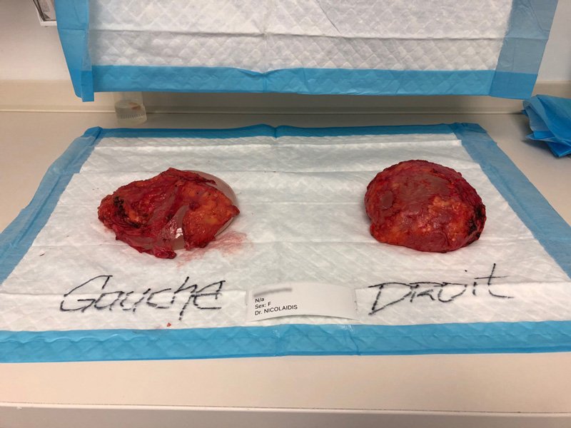After Surgery - Capsules